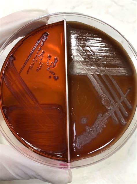 pseudomonas aeruginosa emb|Pseudomonas aeruginosa Infection .